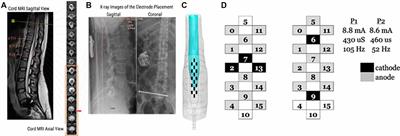 Prolonged Targeted Cardiovascular Epidural Stimulation Improves Immunological Molecular Profile: A Case Report in Chronic Severe Spinal Cord Injury